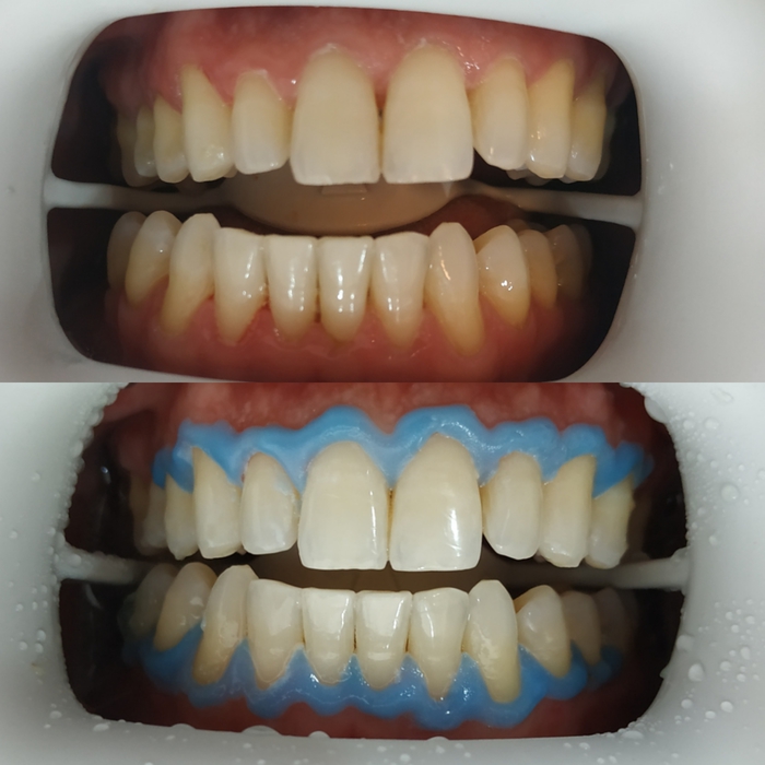 Branqueamento dentário — antes e depois