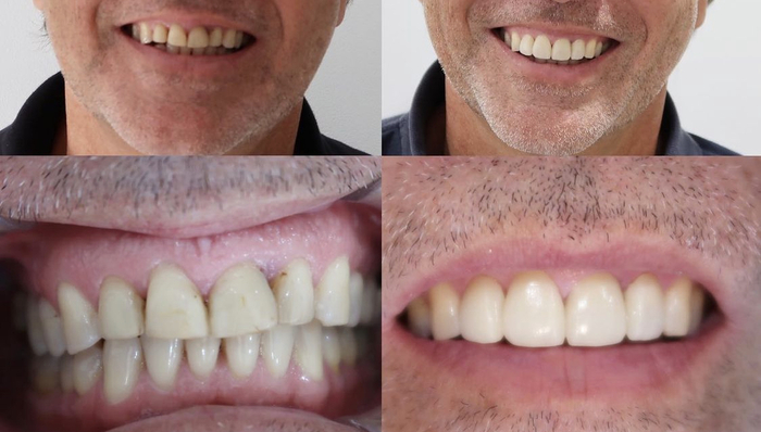 Reabilitação estética — antes e depois