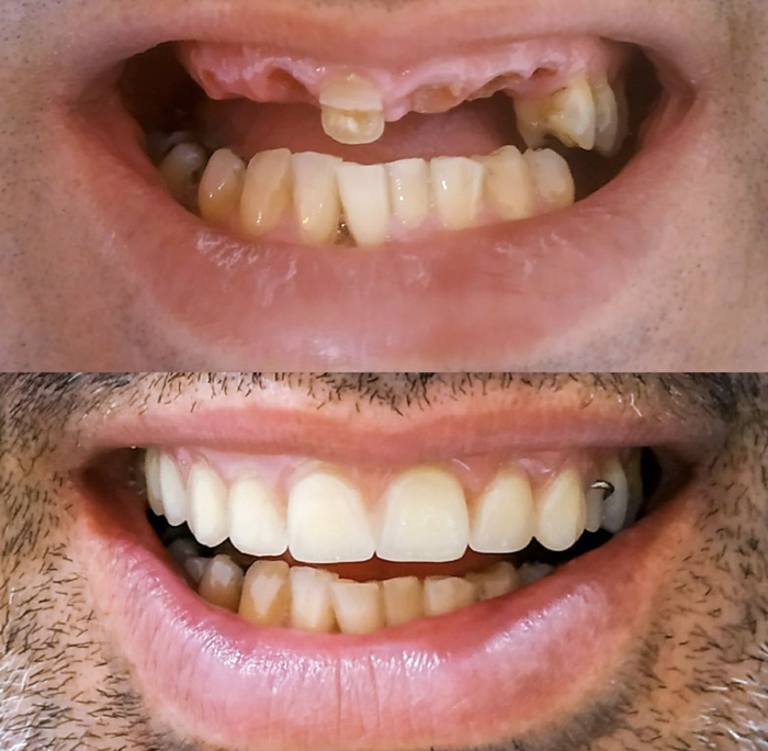 Reabilitação dentária — antes e depois
